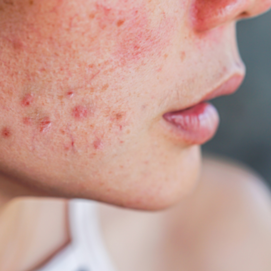 Acne-Prone Skin Facial